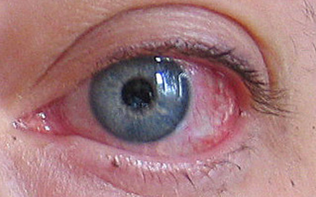 Ailments Breast Milk Has Been Said To Relieve