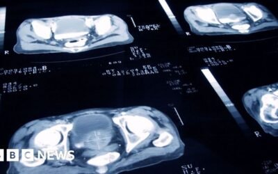 Prostate cancer trial: Radiotherapy doses can be cut safely