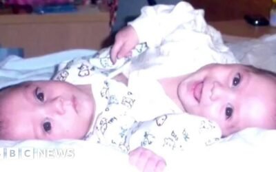 Conjoined twins meet at London hospital that treated them