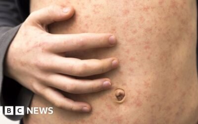 Measles outbreak: Your questions answered