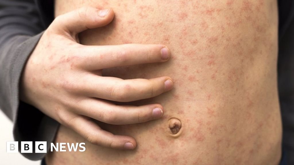 Measles outbreak: Your questions answered